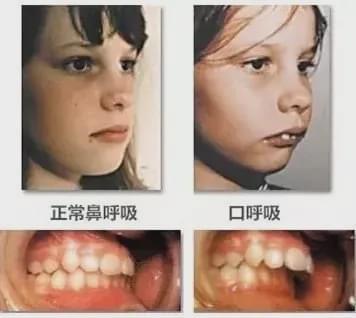 腺样体面容会让孩子变丑，一旦出现不能逆转！家长警惕6种表现