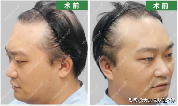 从后脑勺往头顶慢慢脱发,额前脱发植发效果如何