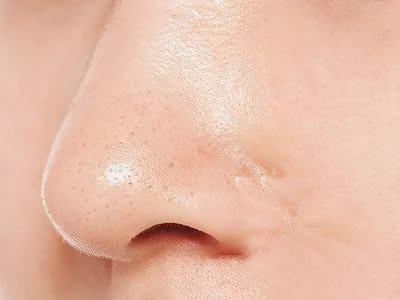 5分钟get到快速去掉黑头的小妙招,黑头比较严重祛黑头最有效的方法