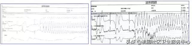 早期心梗心电图能查出来吗,警惕这种要命的心电图表现