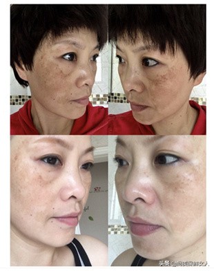 30岁前容易长斑的原因,容易长斑是不是黑色素太多