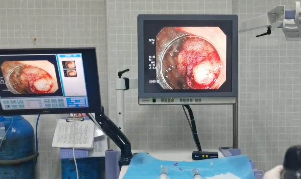 胃肠镜发现有息肉严重吗,肠镜多大息肉可内镜下切除