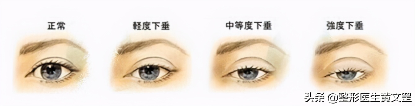 黑眼珠一定是圆吗,黑眼珠全部露出来眼睛大吗