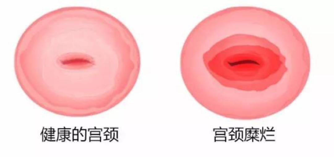 你知道宫颈糜烂的危害是什么吗,宫颈糜烂不是病别再被忽悠了