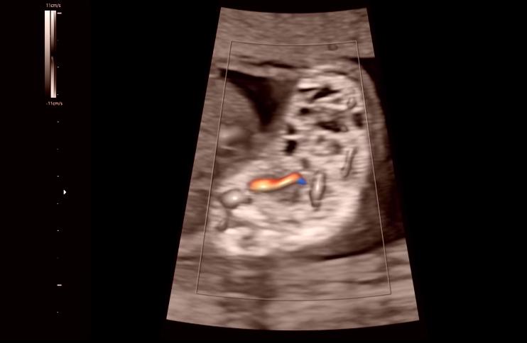 腹中胎儿长出肿瘤，孕妇忍着剧痛，给胎儿打麻药做手术