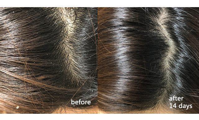 去屑还要注意这3点,控油去屑告别困扰