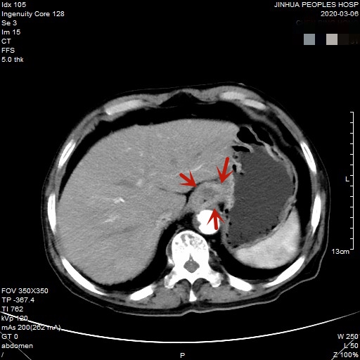 贲门癌80岁手术好还是保守治疗好,医生建议80岁老人做贲门癌手术