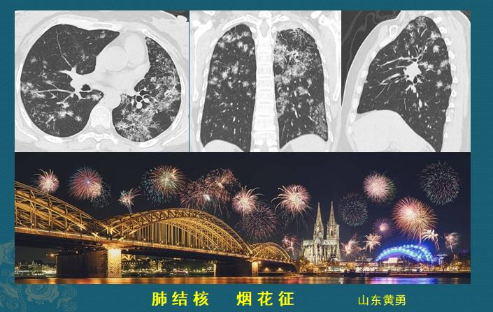 肺结核预防性治疗需要休学吗,高中得肺结核休学半年会留级吗