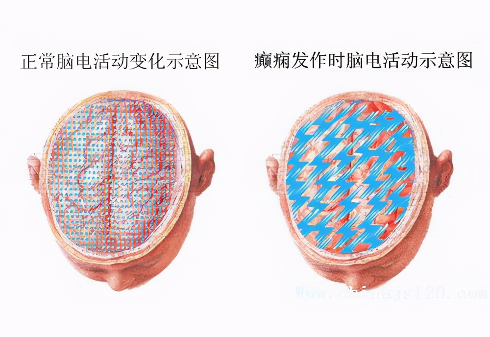 大脑异常放电就一定是癫痫吗,脑电波异常放电没有癫痫症状