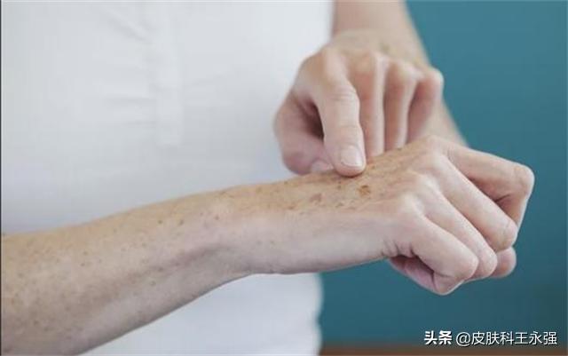 老年斑消除最好的方法皮肤科,长了老年斑怎么食疗