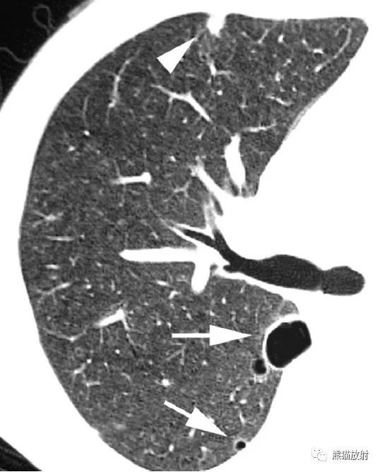 长期卧床病人肺部并发症,卧床患者肺部感染并发症