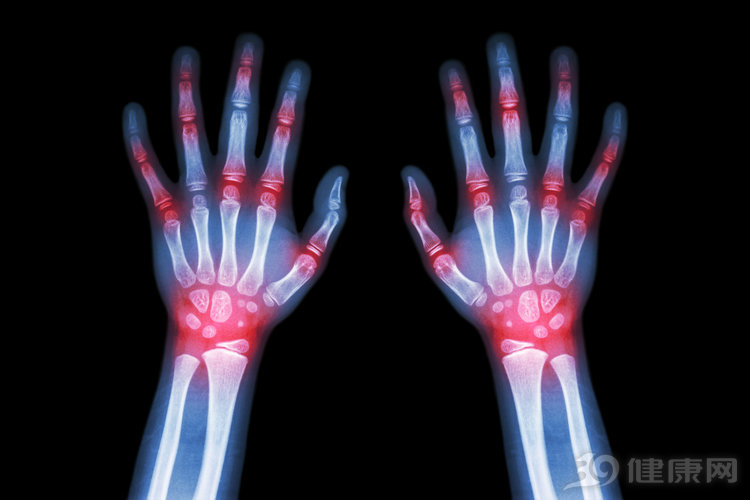 痛风引起膝盖疼痛的症状怎么治疗,膝盖痛风但是又不知道是哪里疼