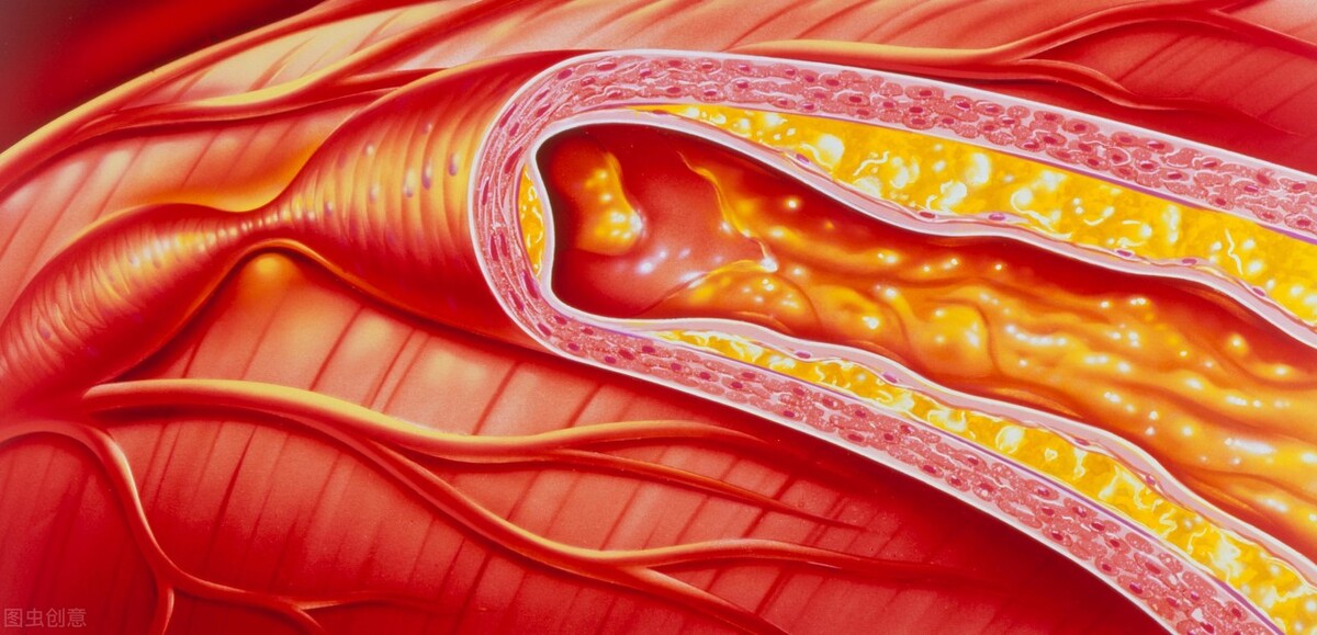 冠脉狭窄放药物球囊好还是支架好,冠脉左前降支60-70狭窄要做支架吗