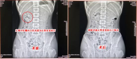 21岁小伙结石,19岁男生得肾结石的记录