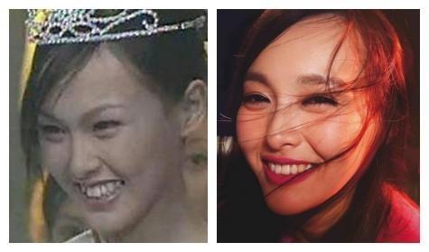 牙齿科普整牙堪比整形,整牙堪比换脸真的假的