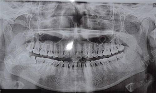 种植牙第一次拆线后的步骤,种植牙二期修复取模的步骤