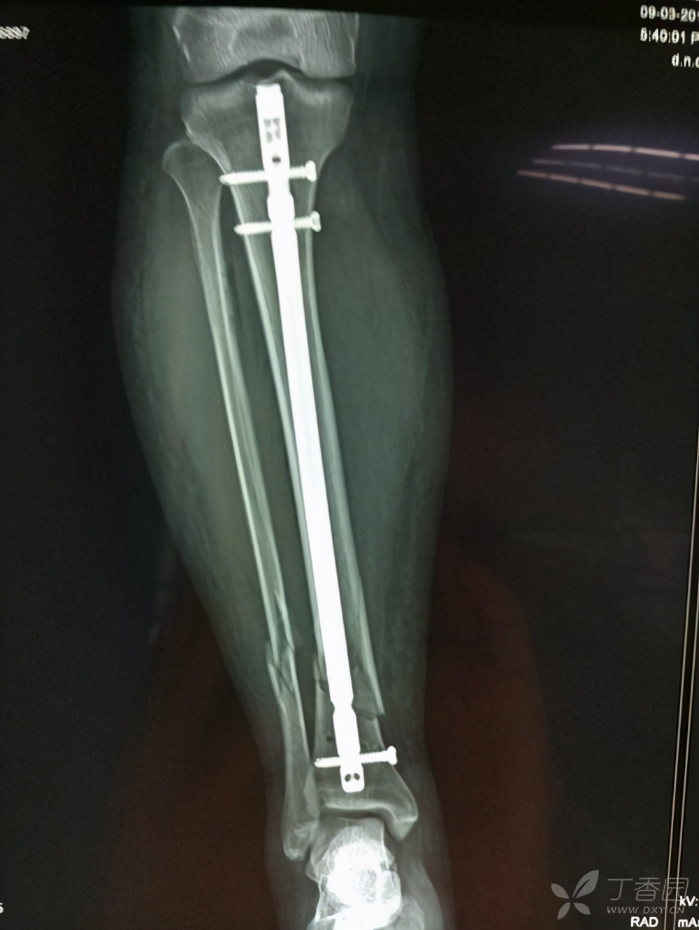 骨折上的钉还用取出来吗,骨折放的钢板是铁的吗