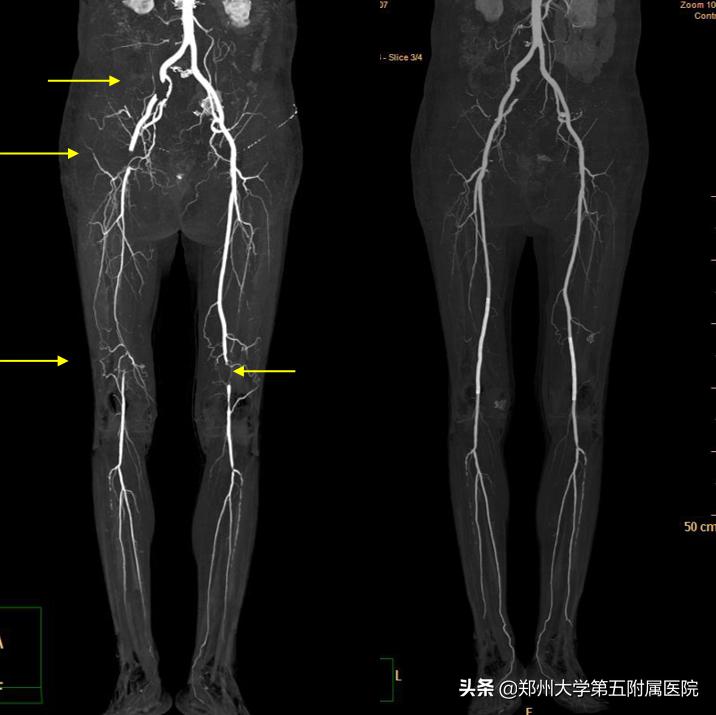 腿上放支架的风险和副作用,腿上放了钢板拿出来有后遗症吗