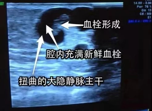 我静脉曲张最近老是疼怎么办,我静脉曲张了应该怎么治疗