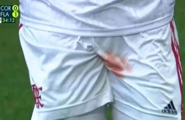 被踩裆+出血！弗拉门戈后卫被对手伤到*处私**，令人心疼不已