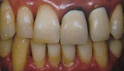 全瓷牙和烤瓷牙到底哪个好,烤瓷牙和全瓷牙优缺点及价格