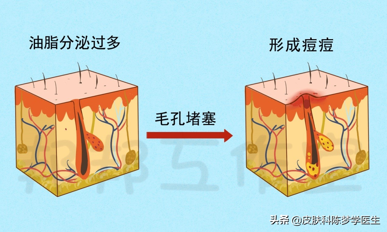 青春痘怎么快速消除不用药物,脸上起青春痘用什么中草药偏方好