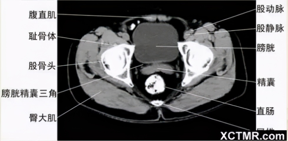 女性盆腔ct断层解剖结构图,女性盆腔脏器ct解剖