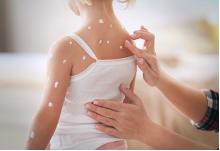 孩子得了水痘怎么办啊,成年人得了水痘痛不欲生