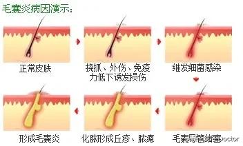 *疮痤**和毛囊炎完全不是一种病，正确区别，不可一概而论