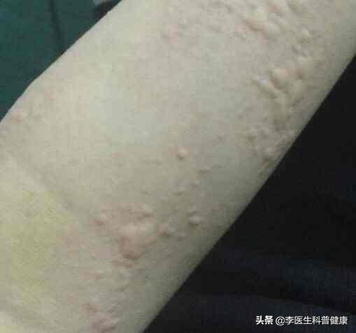热的荨麻疹怎么治疗才能彻底根除,荨麻疹为什么到热天就发呢