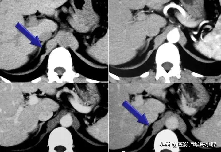 「精品课件」胸部膈肌的解剖及常见病变影像的表现
