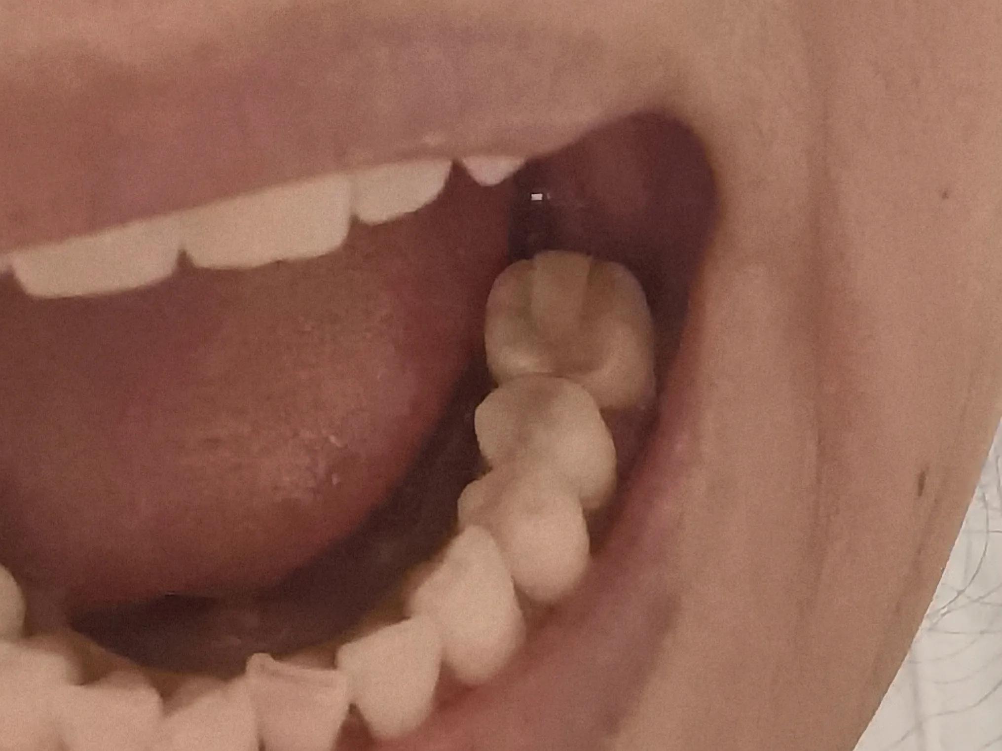 60后阿姨看牙经历：根管治疗后牙依然疼，持续一年不能用为什么？