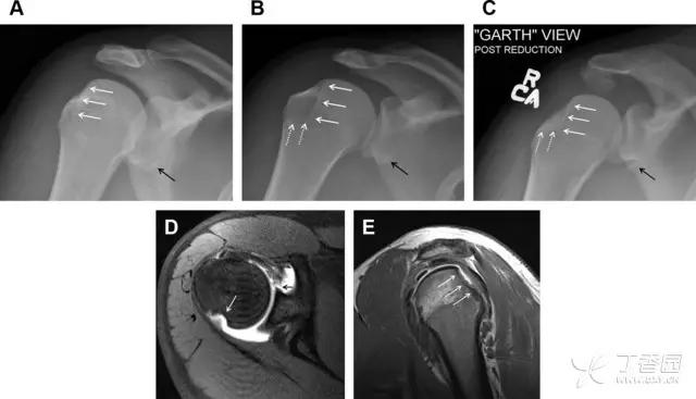 放射科夜班病例大全,放射科容易漏诊的骨折