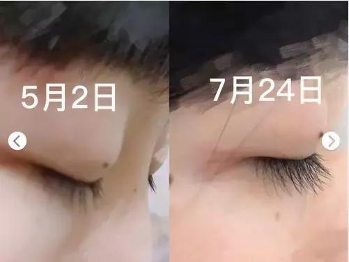 改善眼袋仅980元不开刀让你更出众,消除眼袋细纹大概多少钱