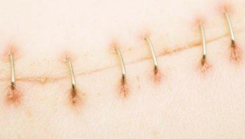 手术刀口上有订书钉怎么回事,手术伤口为什么要用订书针缝线