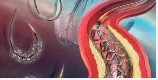 介入疗法的未来前景,介入治疗快速发展