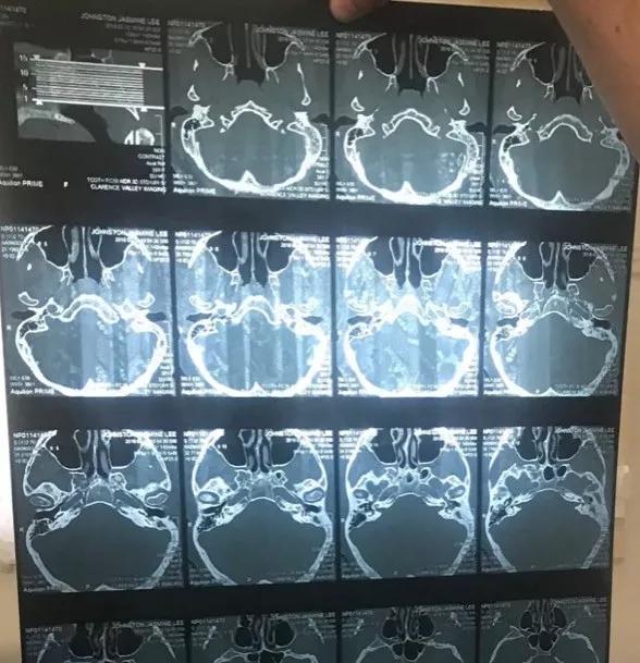 用棉签掏耳朵的危害动画,用棉签掏耳朵对身体有害吗