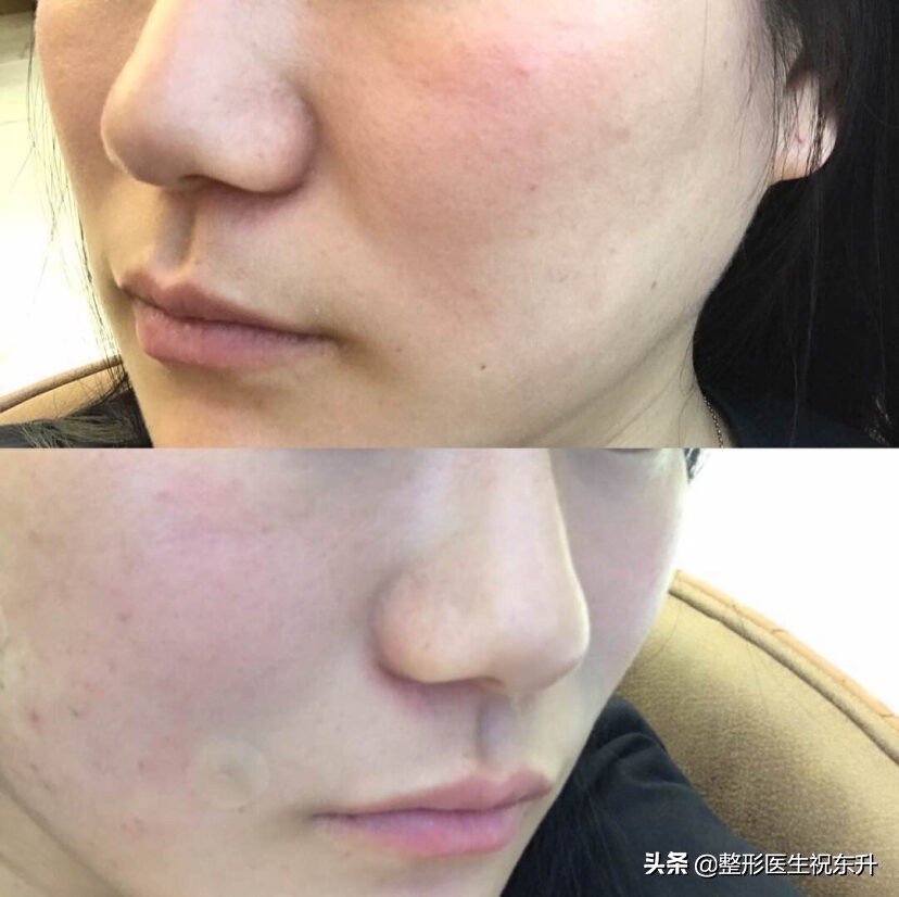 脸上有法令纹去除最好的方法,脸上法令纹怎么去除