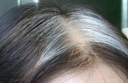 16岁青少年长白发原因,高中生狂长白发怎么回事