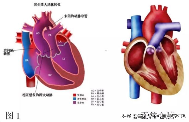 婴儿心脏血管错位手术成功了吗,婴儿心脏动脉错位