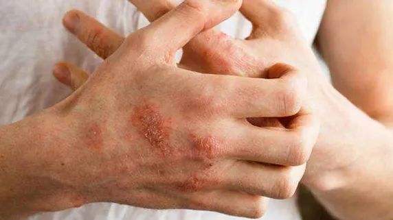 奇痒有水泡,奇痒无比的红疙瘩中间还会长水泡