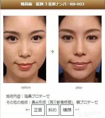 韩国与日本整容哪家强,日本整容vs韩国整容