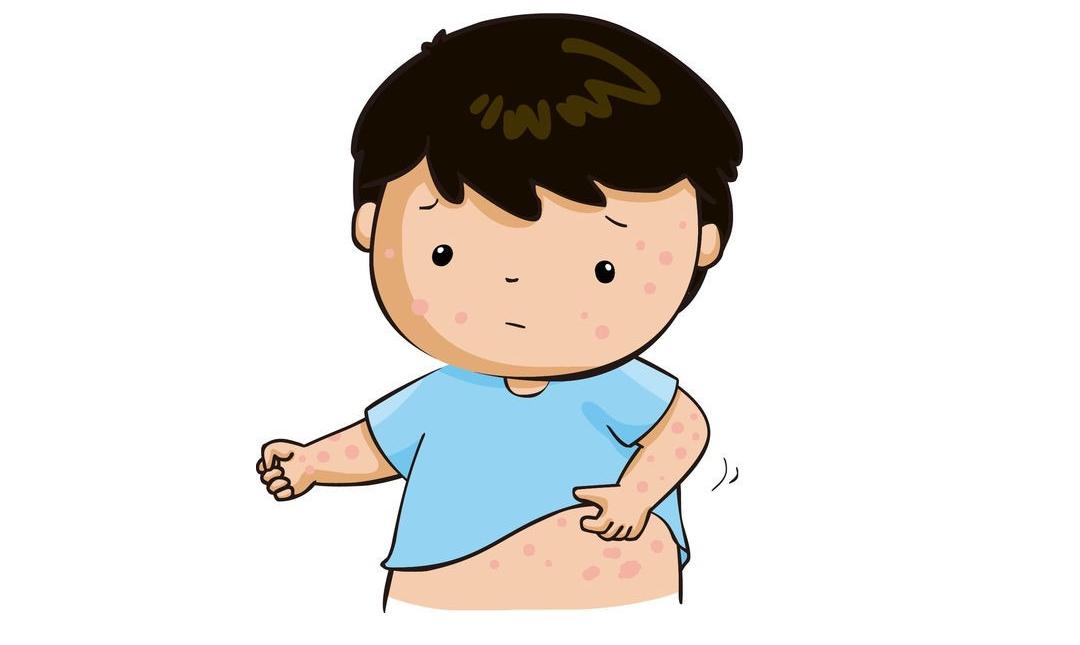 什么是过敏性紫癜症状,过敏性紫癜什么症状怎么治疗