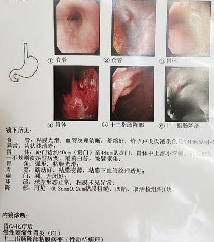 胃癌新辅助化疗实战病例分析