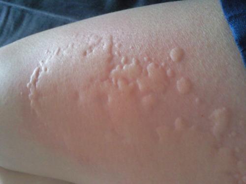 经方学堂刘渡舟伤寒论歌诀,荨麻疹经方论治