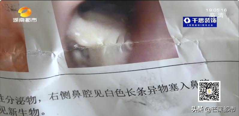 擤鼻涕擤出纱布,擤鼻涕擤出来血块