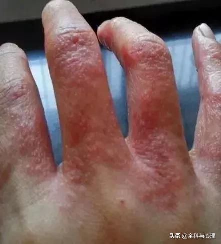 手上手臂起小水泡很痒是怎么回事,手上小水泡抓破了烂了一大片