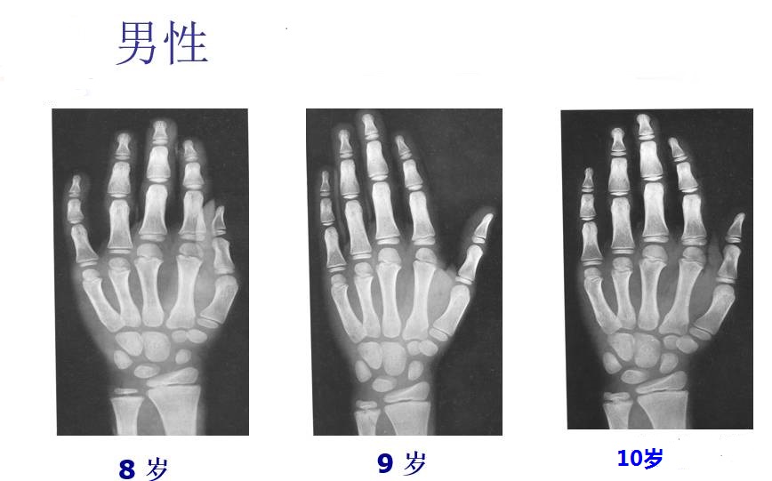 儿童身高矮小检查骨龄,健康科普儿童骨龄片之5问5答