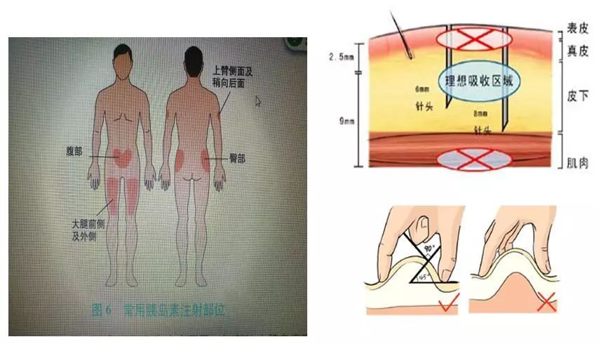 “2型糖尿病伴酮症”入院患者治疗方案及护理、营养卫教指导