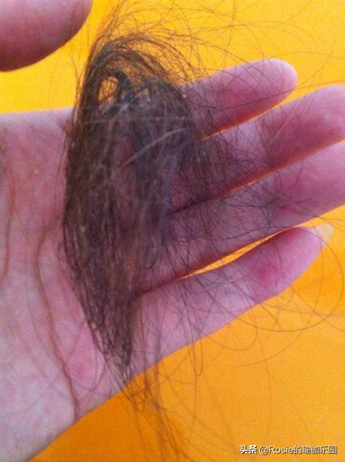 熬夜压力大脱发怎么解决,熬夜压力大头发秃了一块